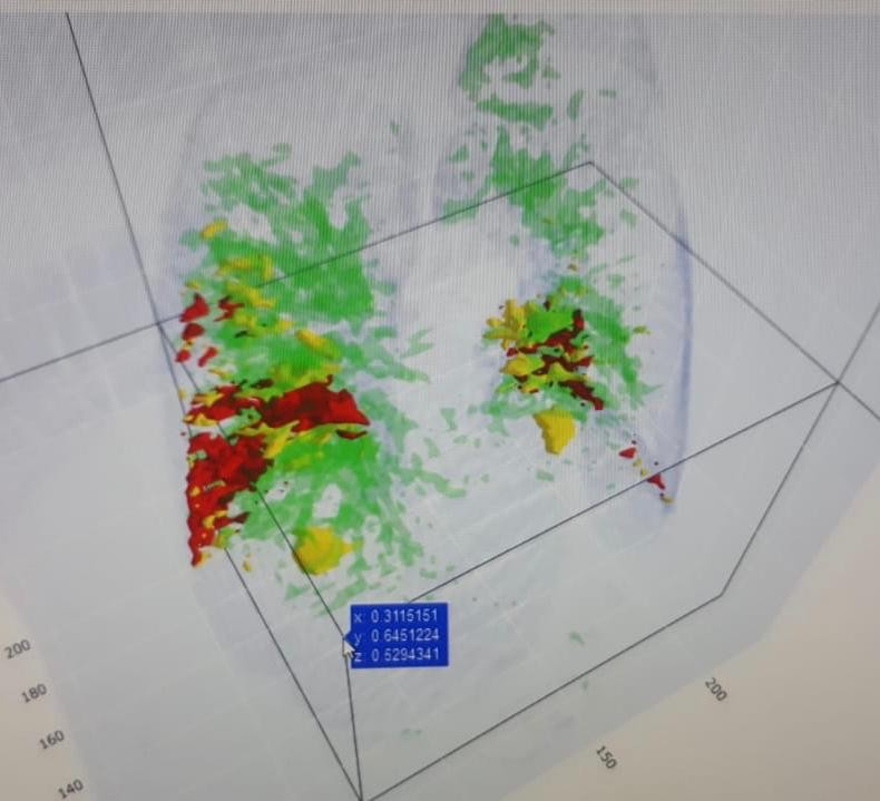 Новый способ интеллектуальной диагностики легких применяют на Ставрополье Новый способ интеллектуальной диагностики легких применяют на Ставрополье