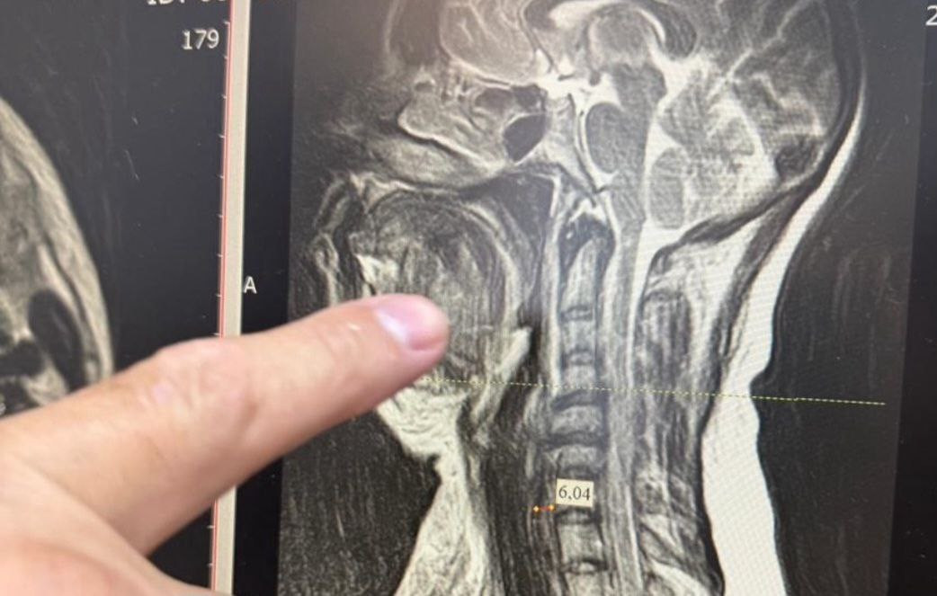 В Ессентуках женщина чуть не погибла из-за разрушенного зуба