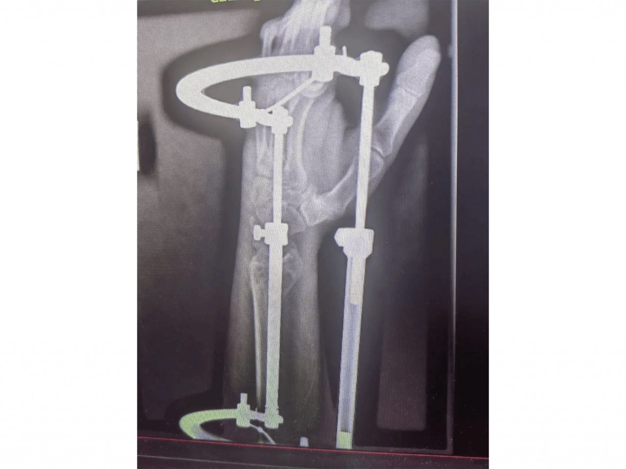 Медики из Ставрополя спасли мужчину, который упал с 6-метровой высоты