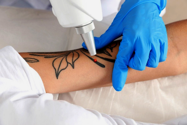 В России растет спрос на удаление татуировок